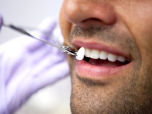 Impianti Dentali a Bari 