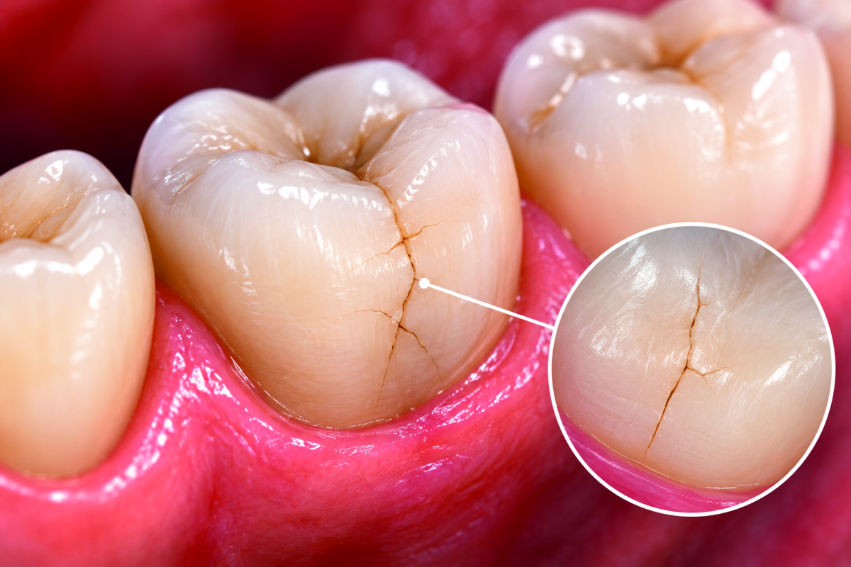 Microfratture dentali: il problema invisibile che può provocare dolore